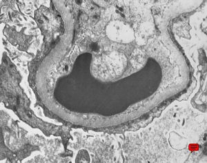 M,58y. | nephrotic syndrome: minimal changes - fusion of pedicles